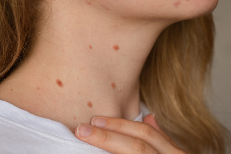 Are Skin Tags Contagious? How to Protect Yourself and Loved Ones