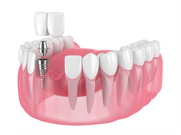 Can Dental Implants Improve Speech Issues