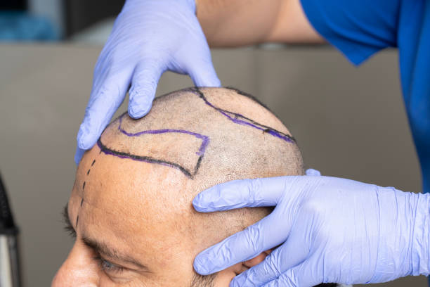 Can FUE Hair Transplant Treat Crown Baldness