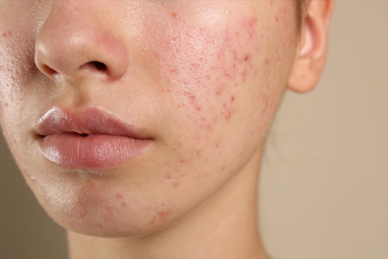 Comprehensive Acne Diagnosis and Treatment