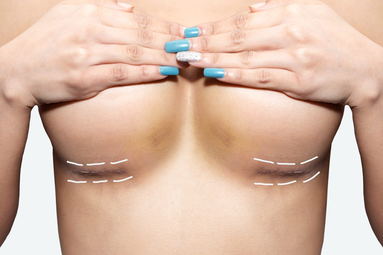 Expert Tips Before Breast Lift Surgery