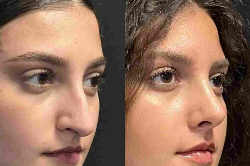 Evaluating the Best Rhinoplasty Surgeon in Dubai: What Truly Matters