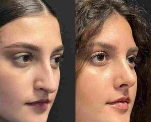 Rhinoplasty in Dubai