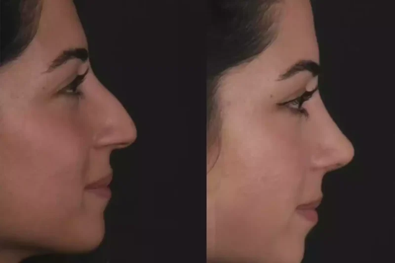 Best Septoplasty Surgeon in Dubai: A Professional Standard of Care