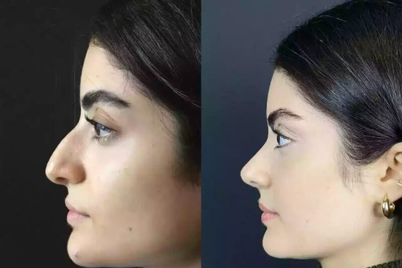 Nose Surgery in Dubai: Your Path to Facial Balance