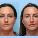 Thread Lift Treatments in Dubai Helps Redefine Jawline and Cheek Structure Naturally