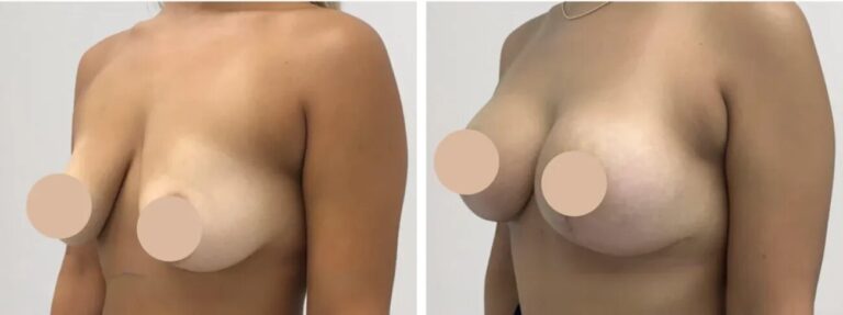 Breast Lift in Dubai