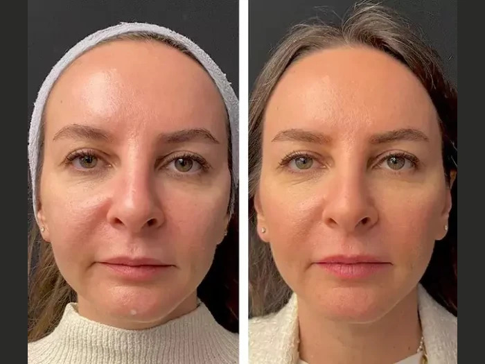 Mesotherapy Treatment in Dubai Compared to PRP and Botox