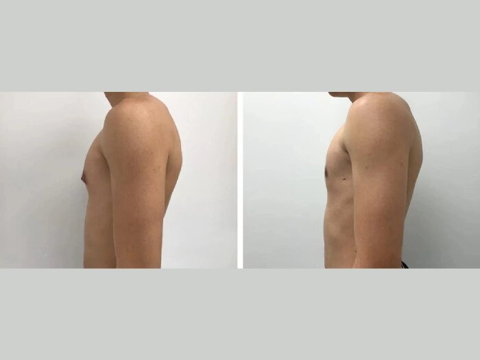 gynecomastia in dubai
