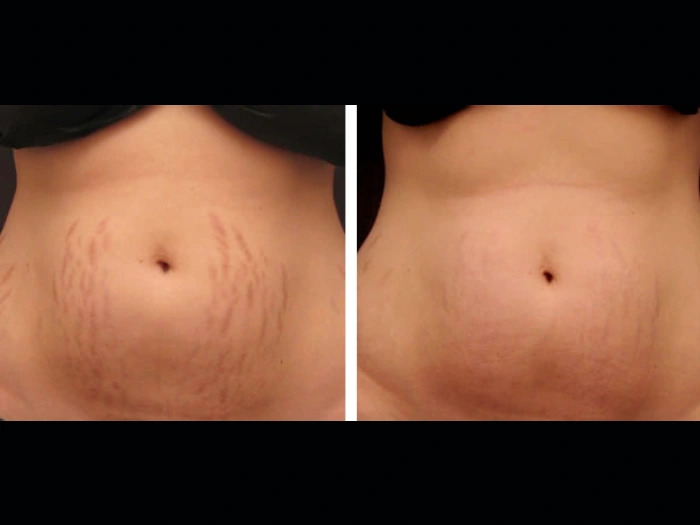 A Revolutionary Lift Using Radiofrequency (RF) Microneedling Treatments in Dubai