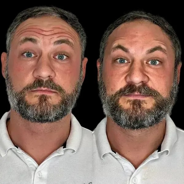 Profhilo treatment in dubai