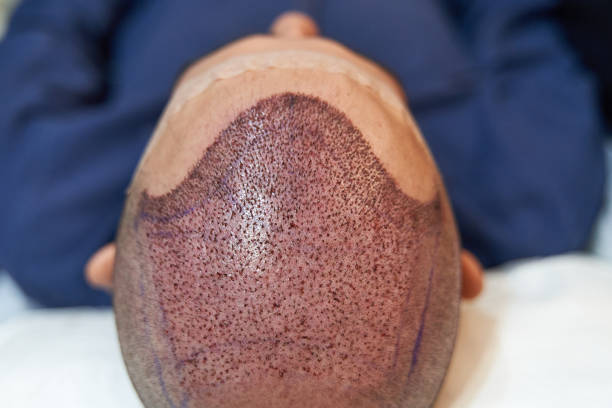 How FUE Hair Transplant Restores Natural Hairlines