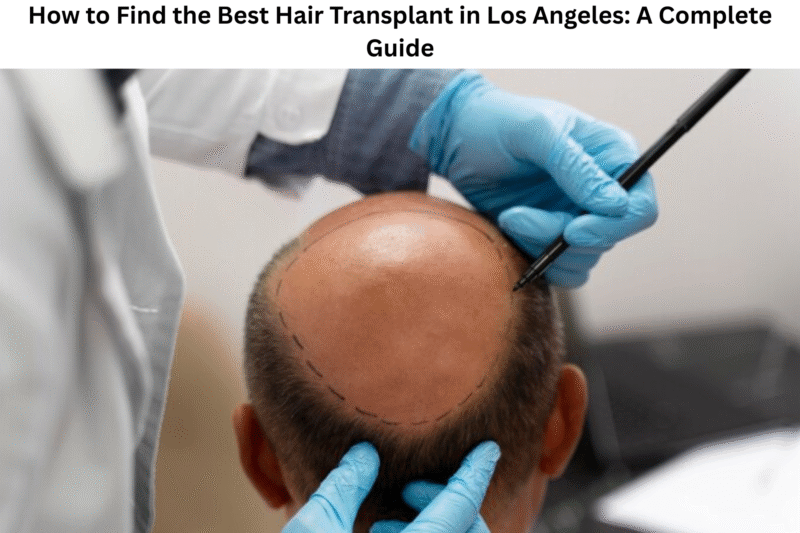 How to Find the Best Hair Transplant in Los Angeles: A Complete Guide