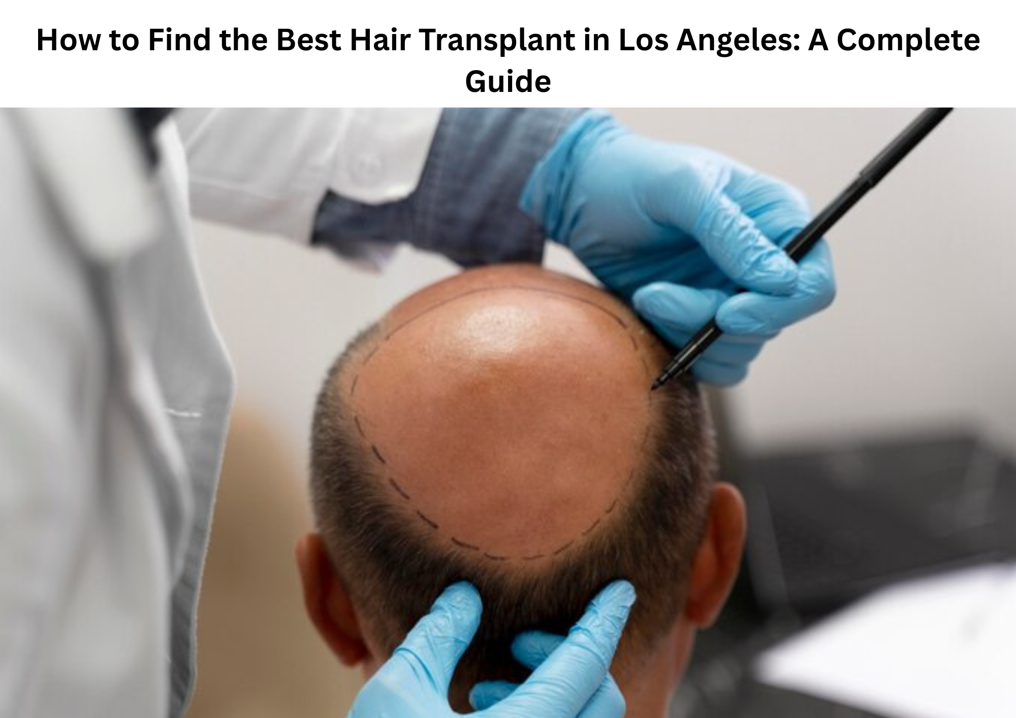 How to Find the Best Hair Transplant in Los Angeles: A Complete Guide