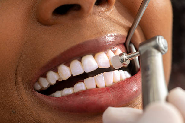 Is Teeth Cleaning Safe for Sensitive Teeth