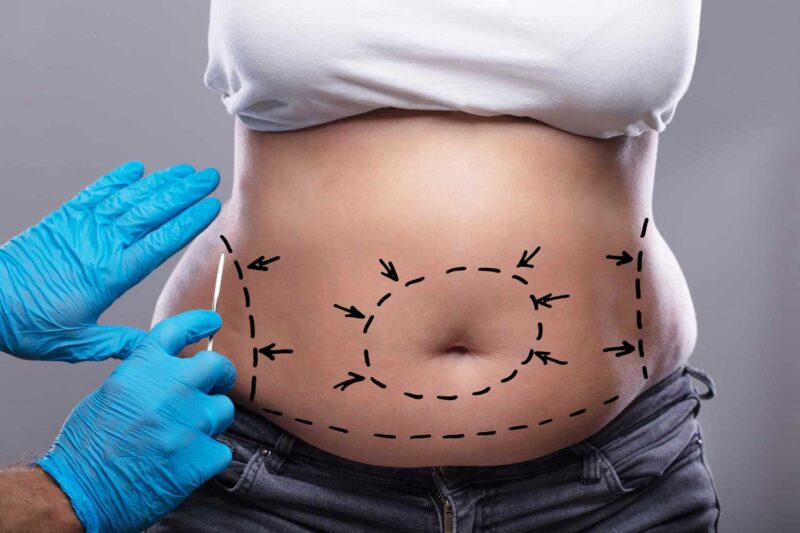 Is Tummy Tuck Suitable After Weight Loss