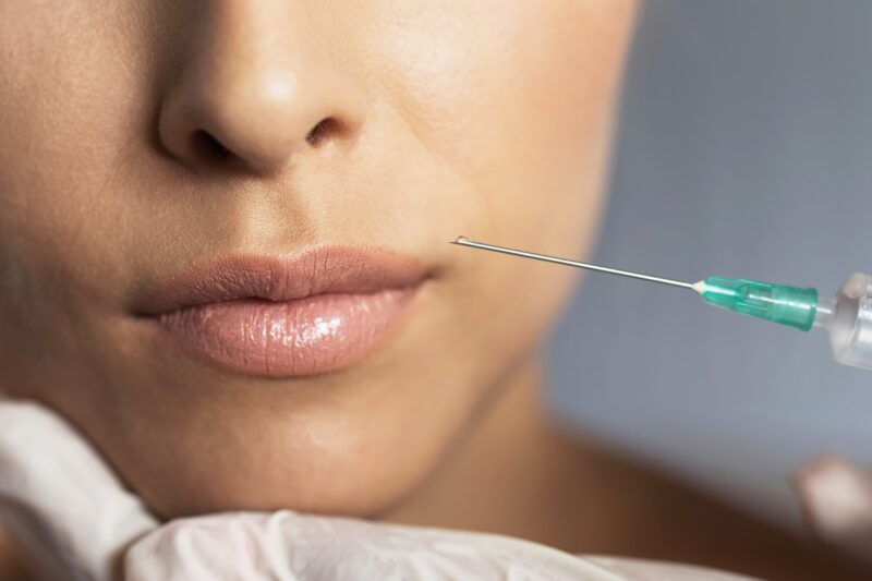 Lip Augmentation for a Youthful and Elegant Appearance