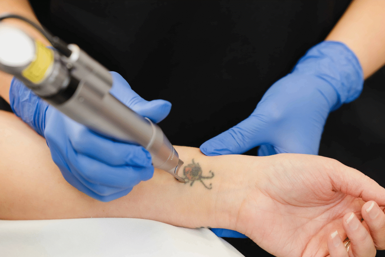 Restore Natural Skin with Tattoo Removal