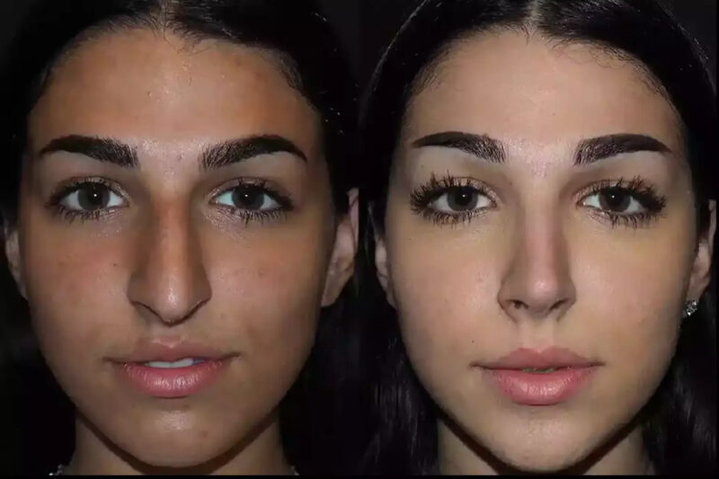 Nose Deviated Septum Surgery in Dubai: What Patients Must Know 