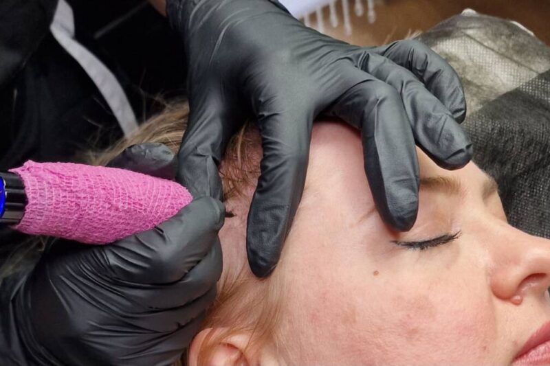 Scalp Micropigmentation for Baldness Coverage