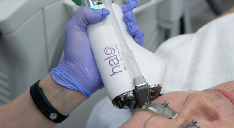 Unlock Smoother Skin with Halo Treatment