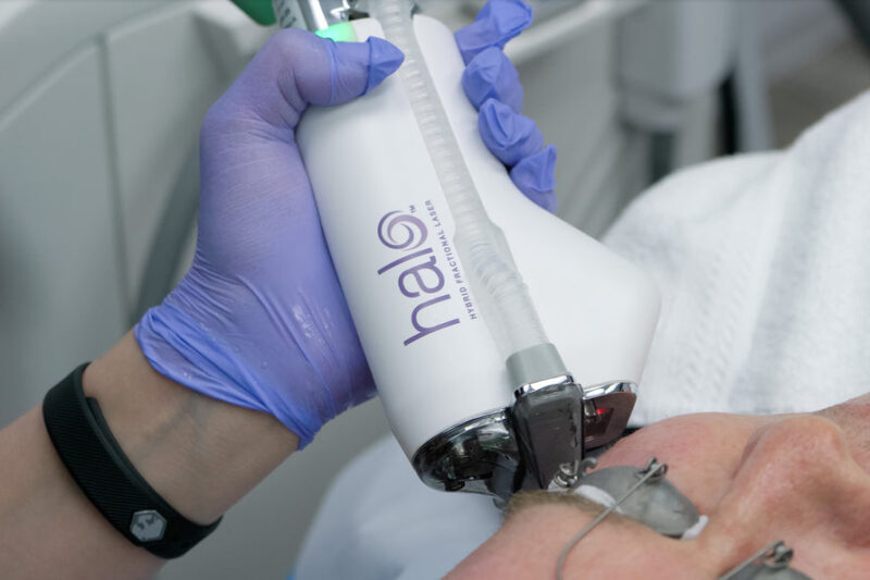 Unlock Smoother Skin with Halo Treatment