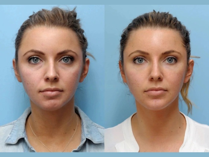 Best Plastic Surgeon in Dubai Thread Lift to Achieve Refreshed Natural Facial Beauty