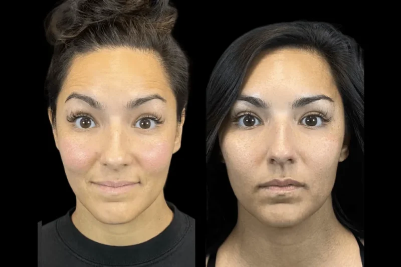 The Best Doctors in Dubai Share Botox Aftercare Secrets for Long-Lasting Results