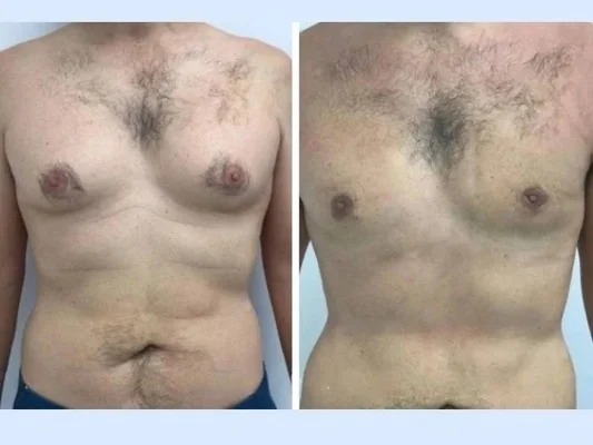 Best Doctors in Dubai for Gynecomastia offering natural-looking outcomes