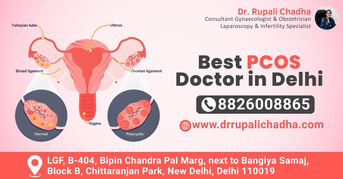 Best PCOS Doctor in Delhi
