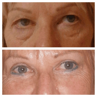 Consultation Time | Best Eye bag removal Surgeons in dubai