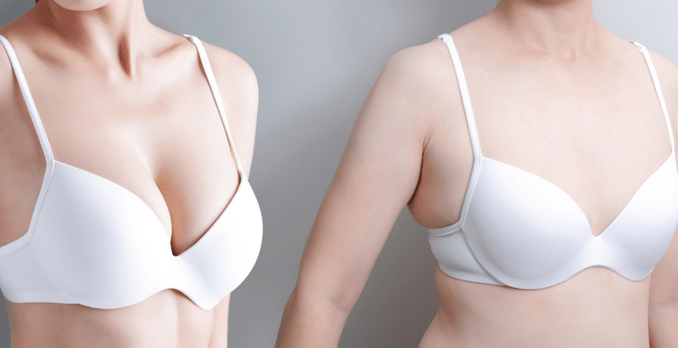 Breast Augmentation