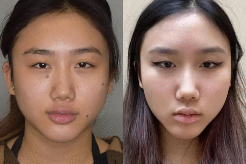 Facial Contouring Secrets of the Best Buccal fat removal Surgeons in dubai