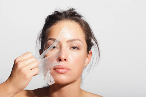 Can Chemical Peel Help With Melasma