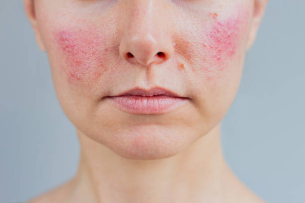 Can the Best Dermatologist Help with Rosacea