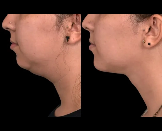 Best Double Chin Removal Surgeons in Dubai for V-Shape Contouring