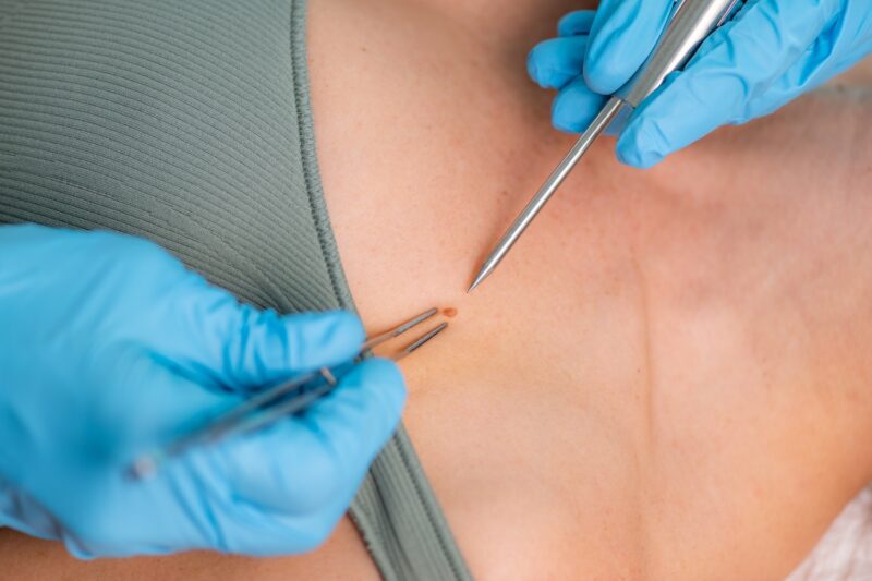 Clearer Skin with Proven Warts Removal Methods