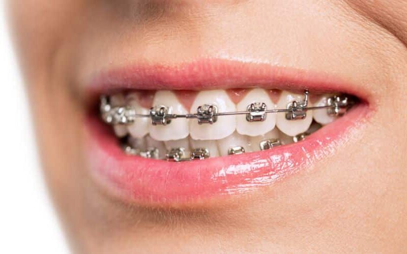 Can Dental Braces Fix Gaps Between Teeth