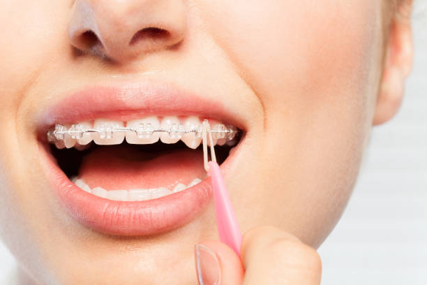 Do Ceramic Braces Help Correct Overbite Problems?