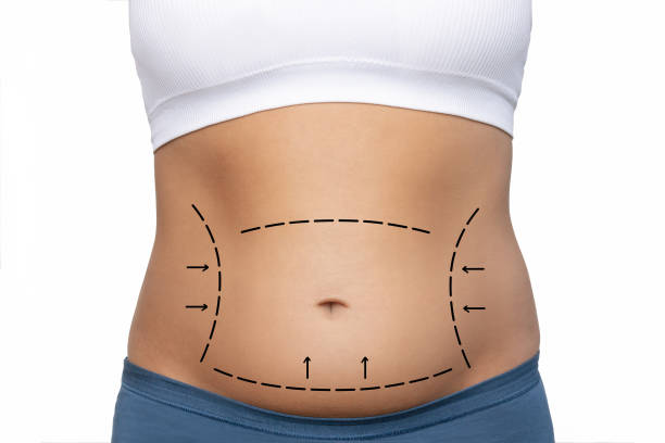 Does Lipo Abdominoplasty Help With Body Contouring