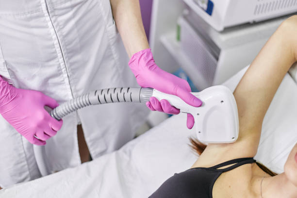 Does MiraDry Treatment Eliminate Sweat Glands Forever?