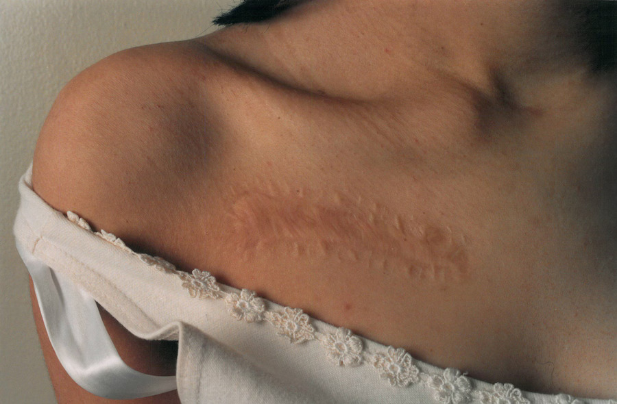 Does Post Surgical Scars Treatment Improve Confidence