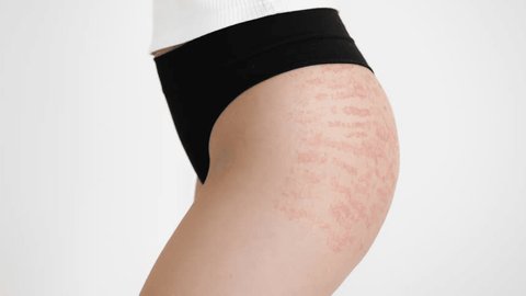 Does Stretch Mark Removal Require Downtime