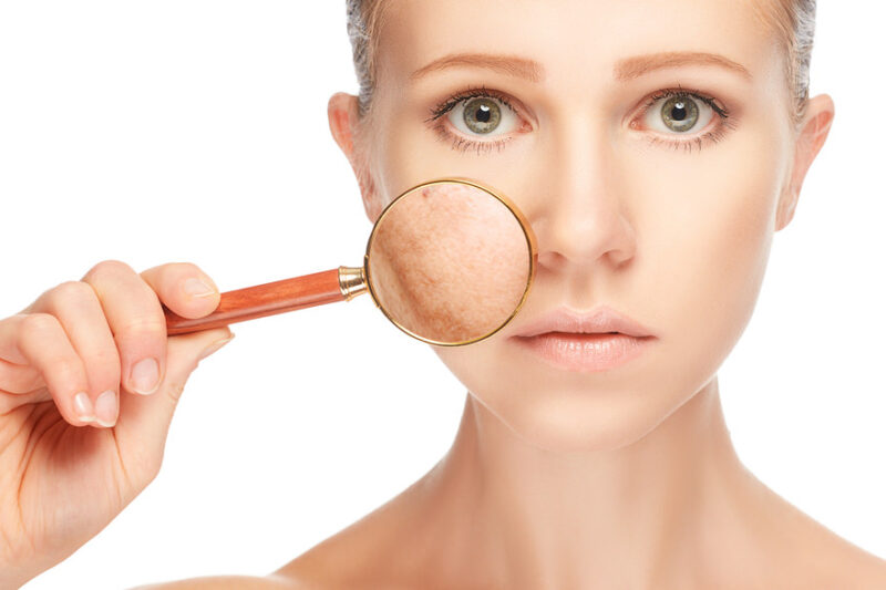 Dose Pigmentation Treatment Reduce Acne Marks