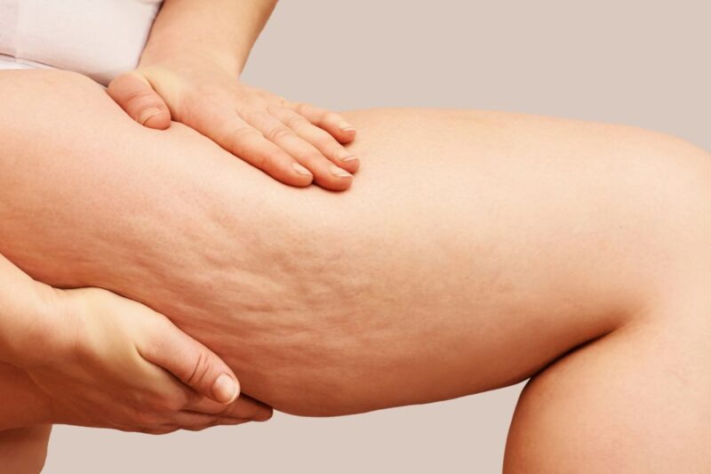 Dose Slimming Treatments Reduce Cellulite