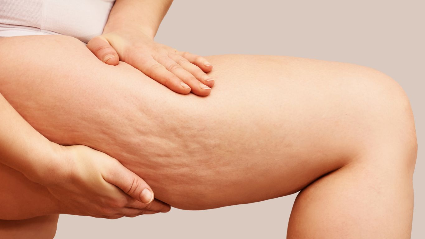 Dose Slimming Treatments Reduce Cellulite