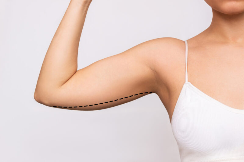 Enhance Your Arm Contours with an Arm Lift