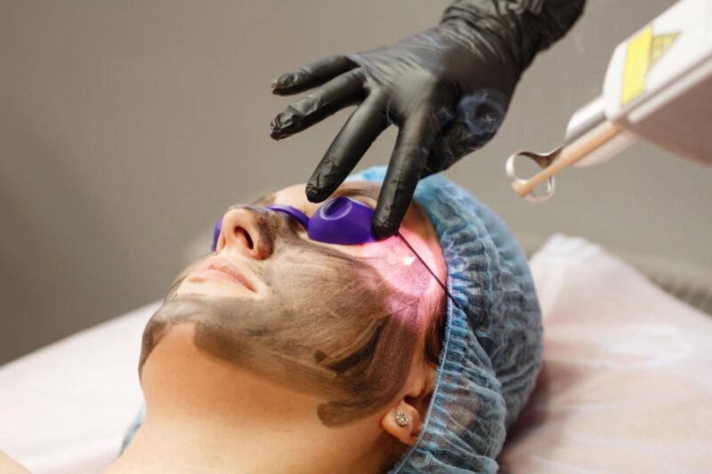 Get Flawless Skin with Laser Carbon Peel