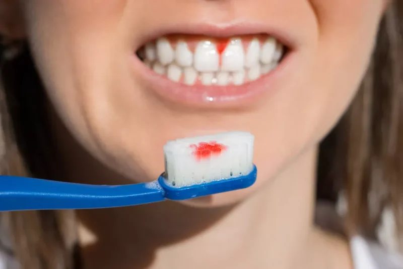 Why Do My Gums Bleed When I Brush or Floss?