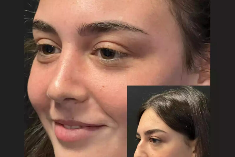 Your Journey to Facial Harmony: Nose Surgery in Dubai